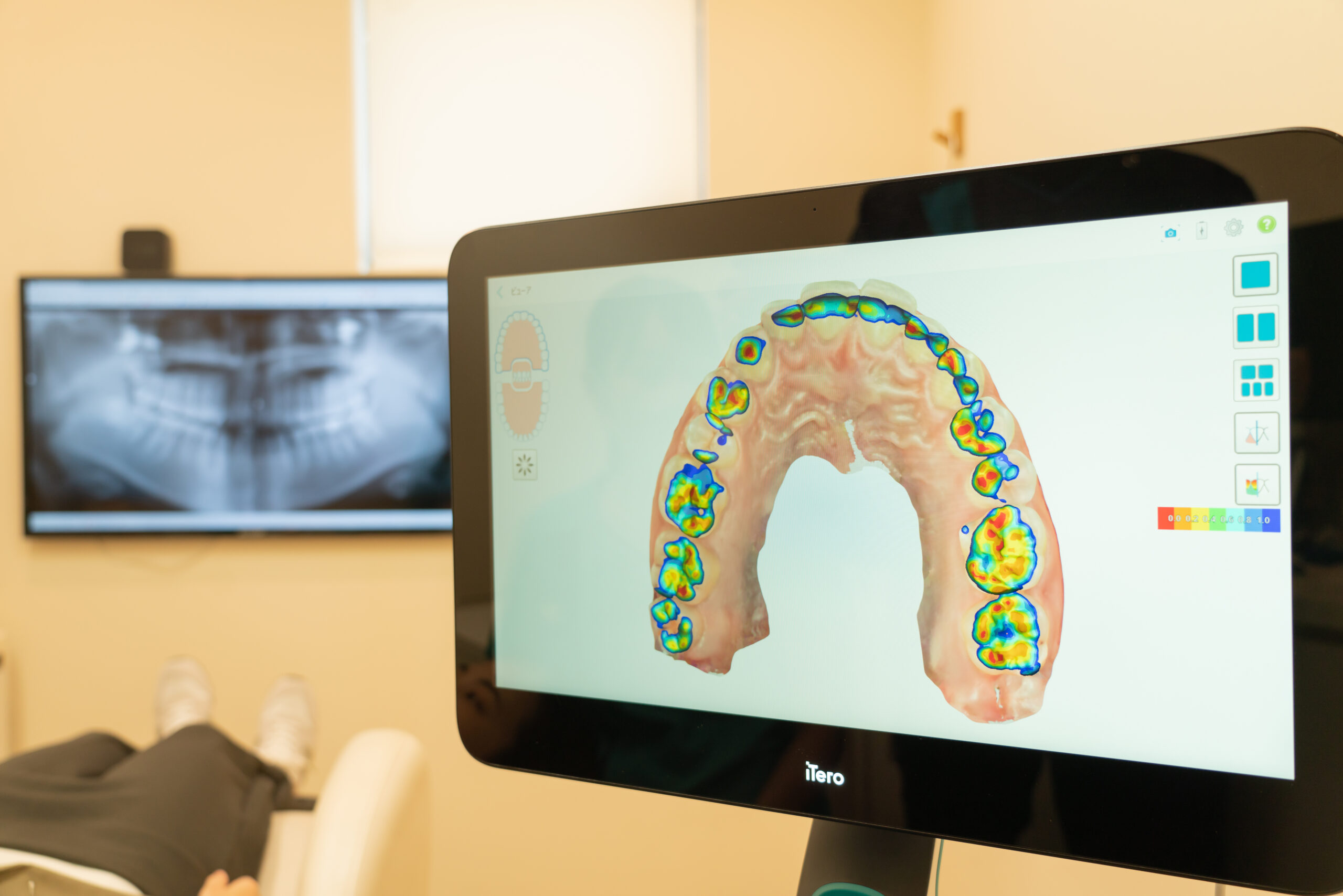 インビザラインでのゴム掛け